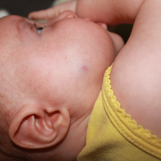 Deep hemangioma on the cheek @ohbotherblog